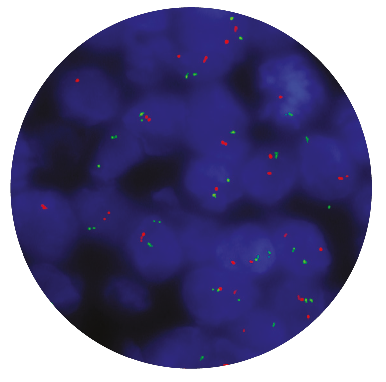 Fluorescence in situ hybridization (FISH) microscope image of the CytoCell EWSR1/ERG Translocation, Dual Fusion probe.