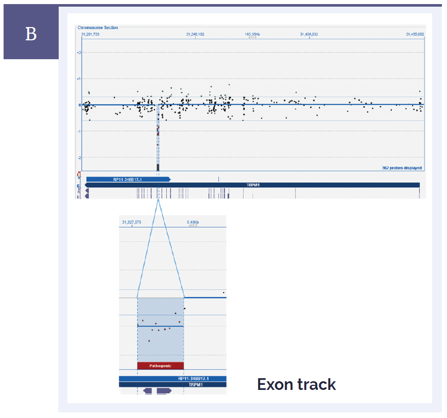 aCGH software data showing a complete view of the TRPM1 gene and a close-up view showing a small 684bp deletion.