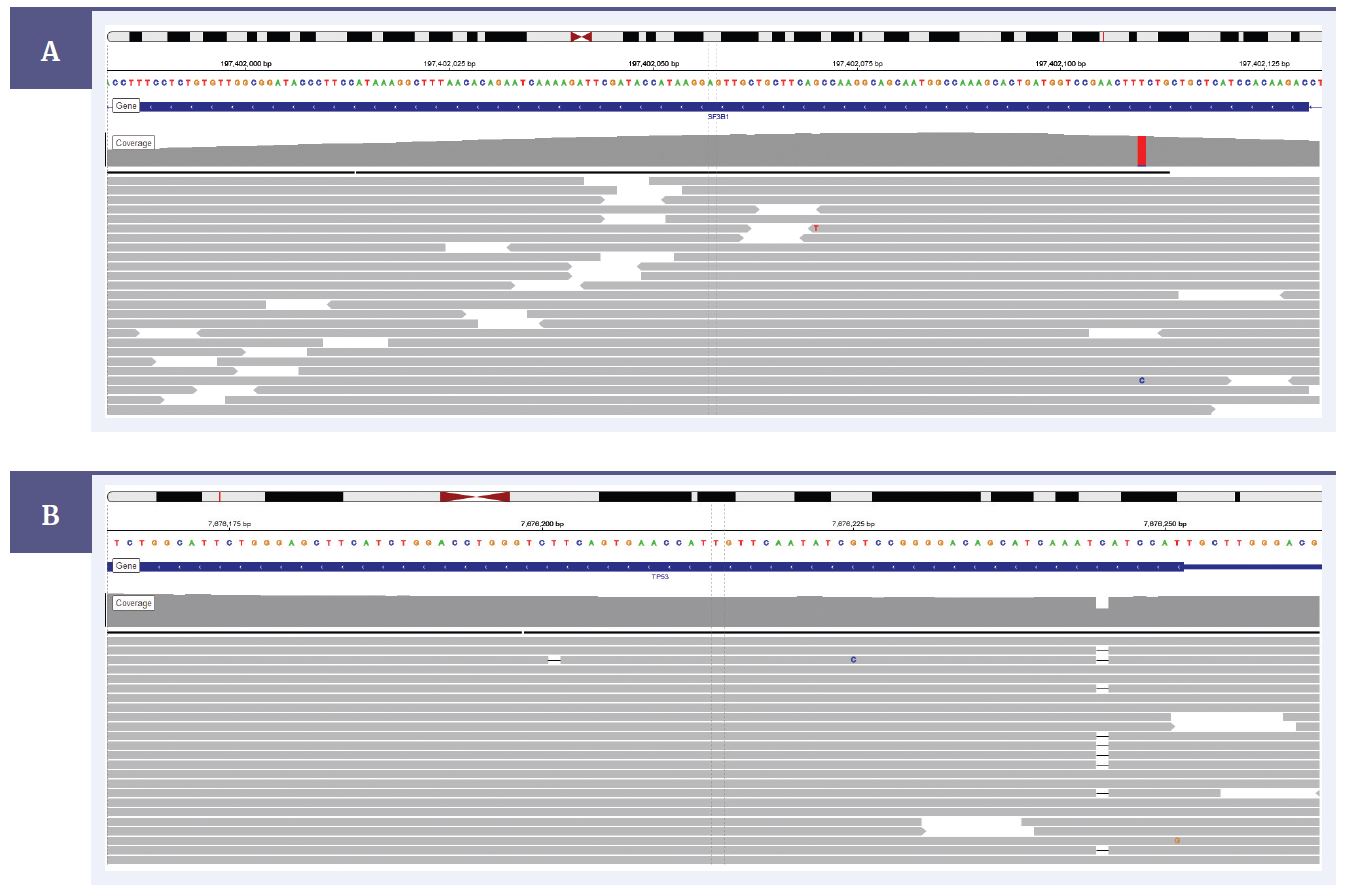 NGS software data showing detection of a SF3B1 exon 15 hotspot variant Lys700Glu and TP53 exon 4 frameshift deletion.