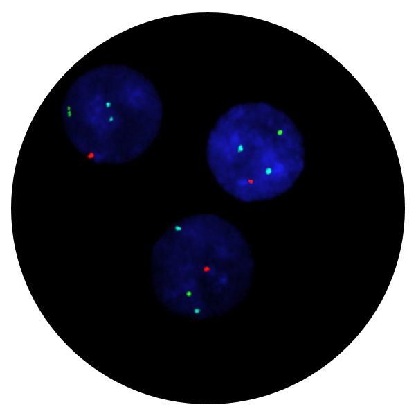 Fluorescence in situ hybridisation (FISH) microscope image of the CytoCell FAST FISH Prenatal X, Y and 18 probe.