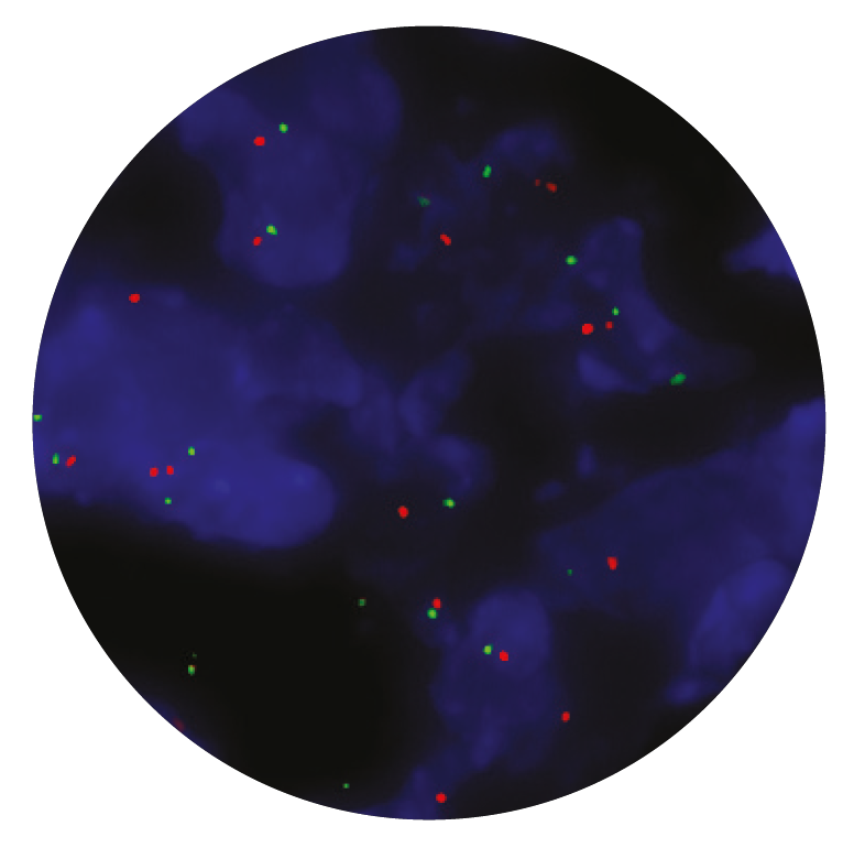 Fluorescence in situ hybridization (FISH) microscope image of the CytoCell ZNF217 Amplification probe.