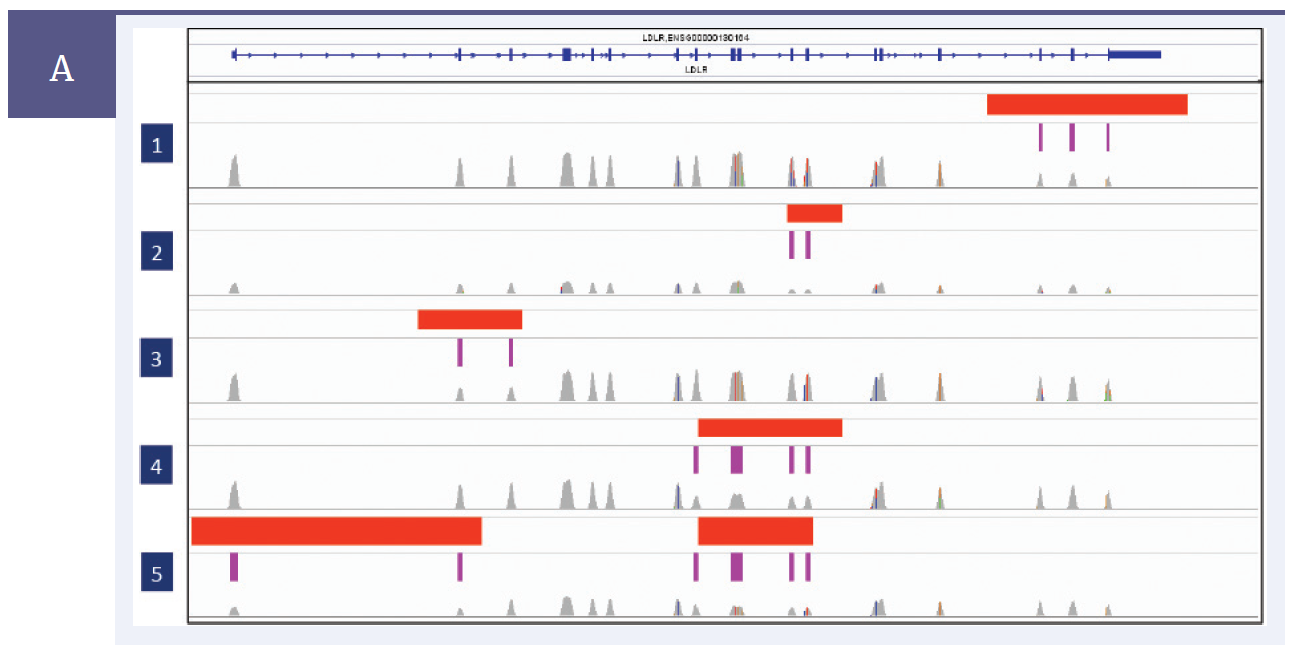 Copy number variation (CNV) in the LDLR gene shown using an Integrative Genomics Viewer (IGV) from the Broad Institute.