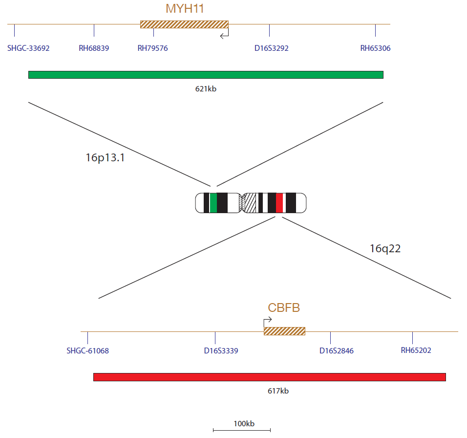 Fluorescence in situ hybridization (FISH) chromosome map showing a probe mix targeting the genes CBFß (CBFB) and MYH11.