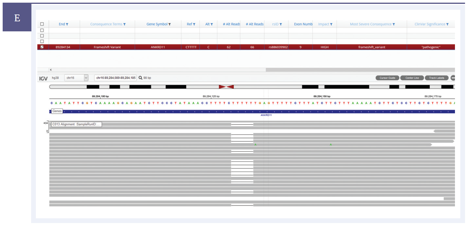 Next generation sequencing (NGS) software data showing an indel detected within the ANKRD11 gene.
