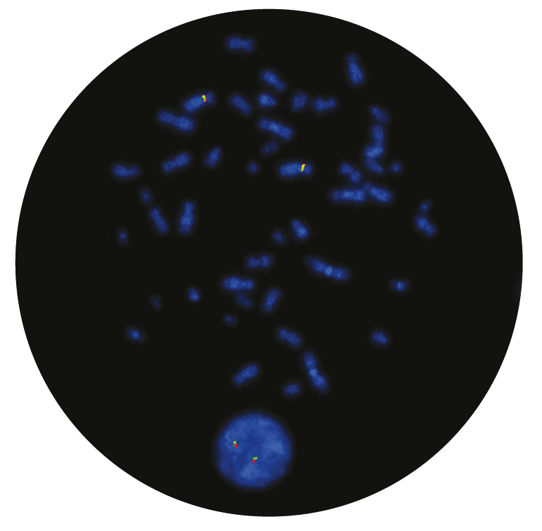 Fluorescence in situ hybridization (FISH) microscope image of the CytoCell FIP1L1/CHIC2/PDGFRA Deletion/Fusion probe.