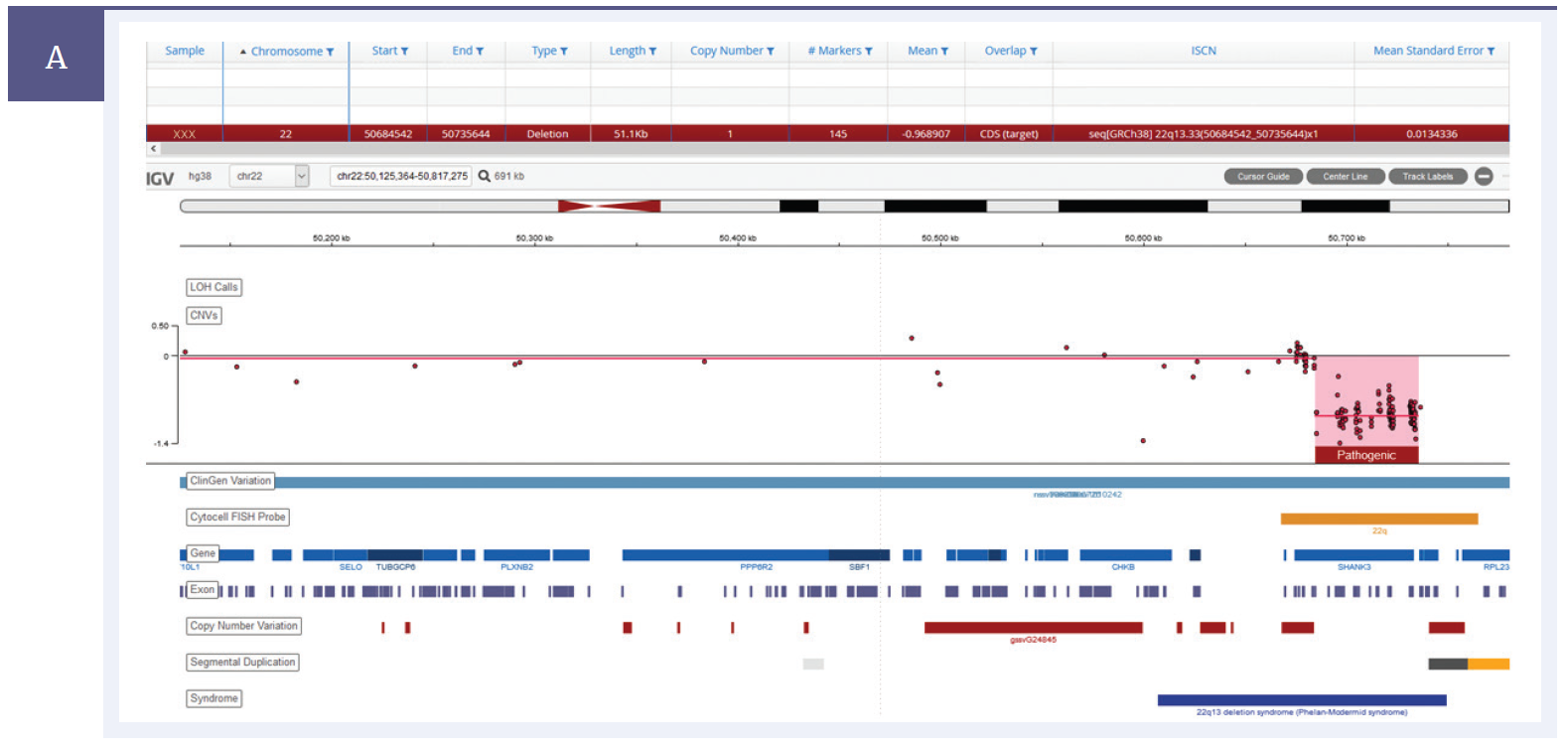Next generation sequencing (NGS) software data showing detection of a 51kb deletion within the SHANK3 gene on chromosome 22.