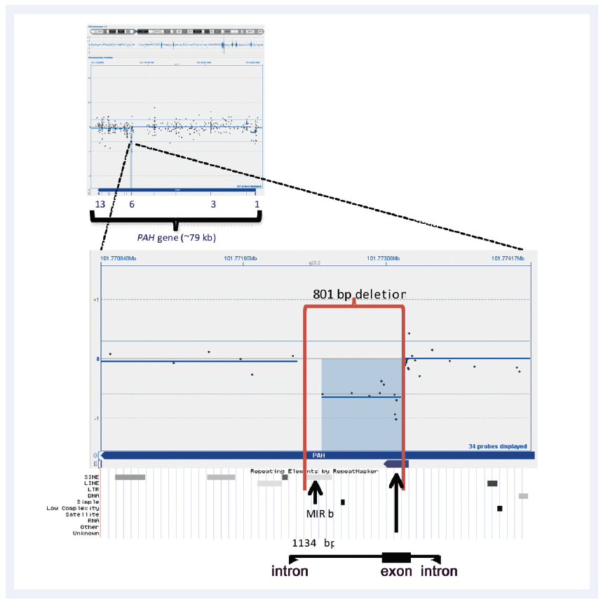 aCGH software data showing a 801bp micro-aberration causing partial deletion of exon 6 in the PAH gene.