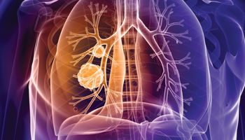 Lung Cancer