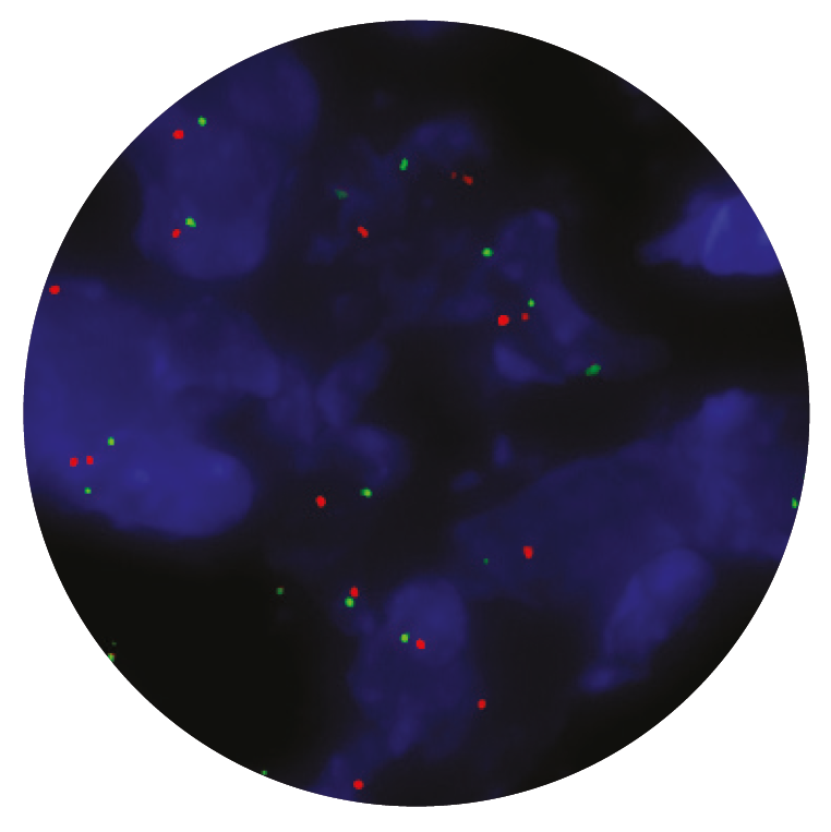 Fluorescence in situ hybridisation (FISH) microscope image of the CytoCell ZNF217 Amplification probe.
