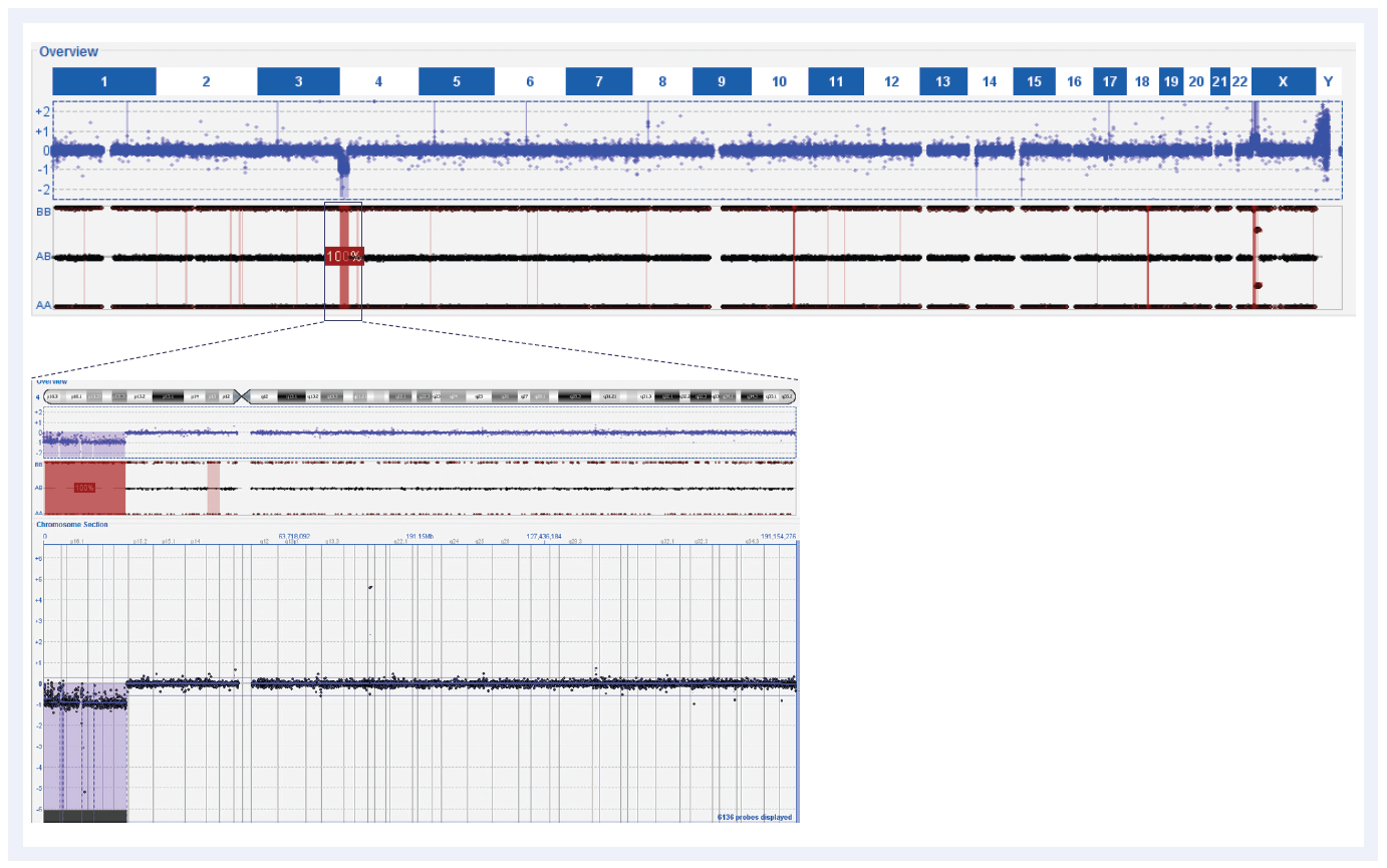 aCGH software data showing a t(X;4) unbalanced translocation and a close-up view of the loss on chromosome 4.
