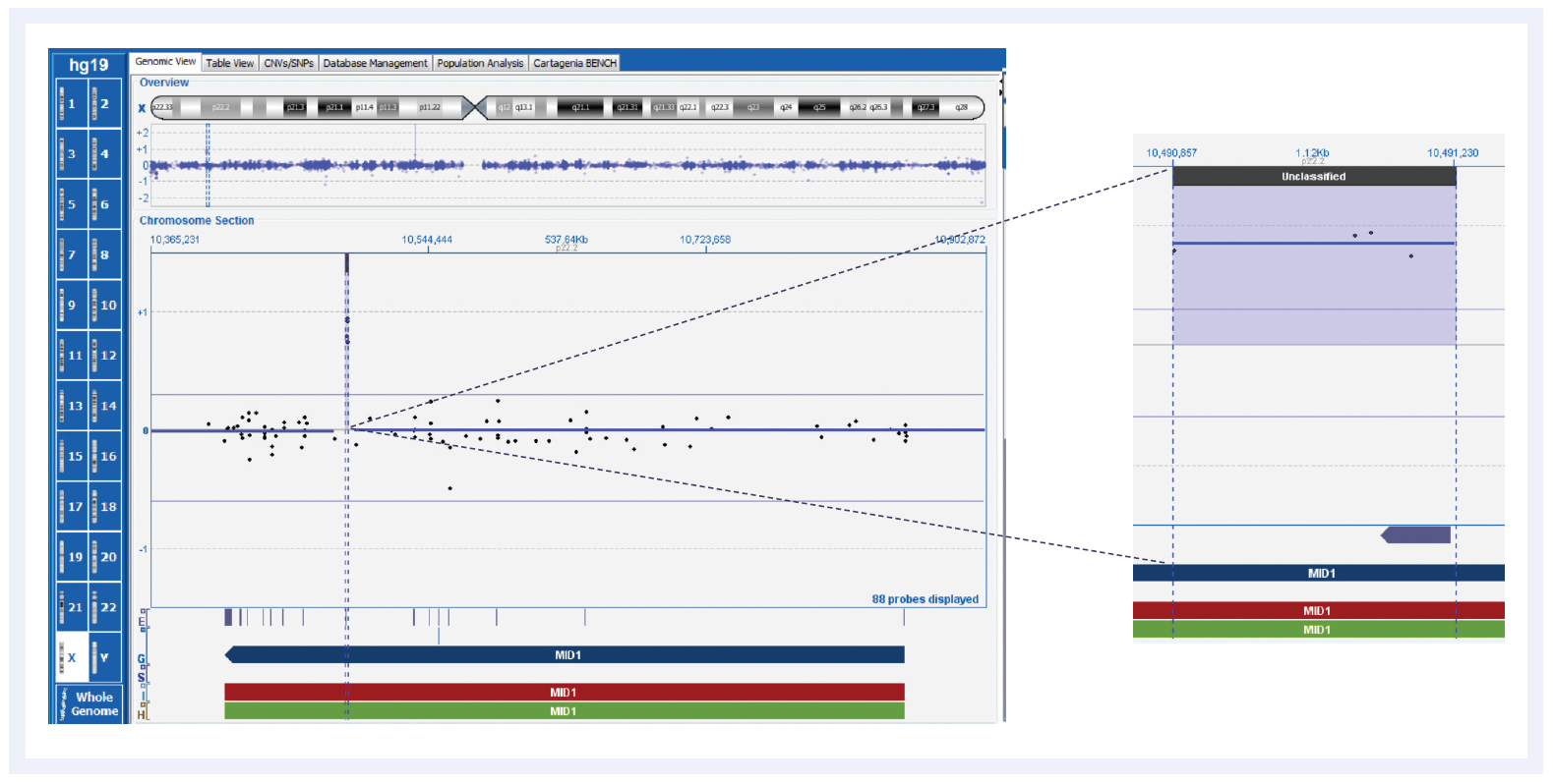 aCGH software data showing a small, single-exon duplication in MID1 associated with Opitz-G syndrome.