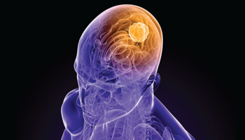 Glioma