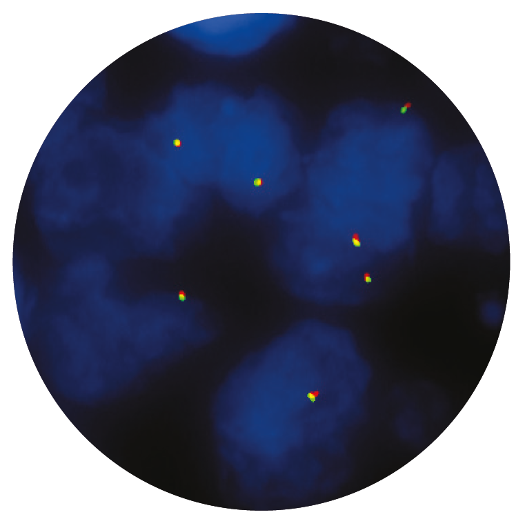 Fluorescence in situ hybridisation (FISH) microscope image of the CytoCell SYT (SS18) Breakapart probe.