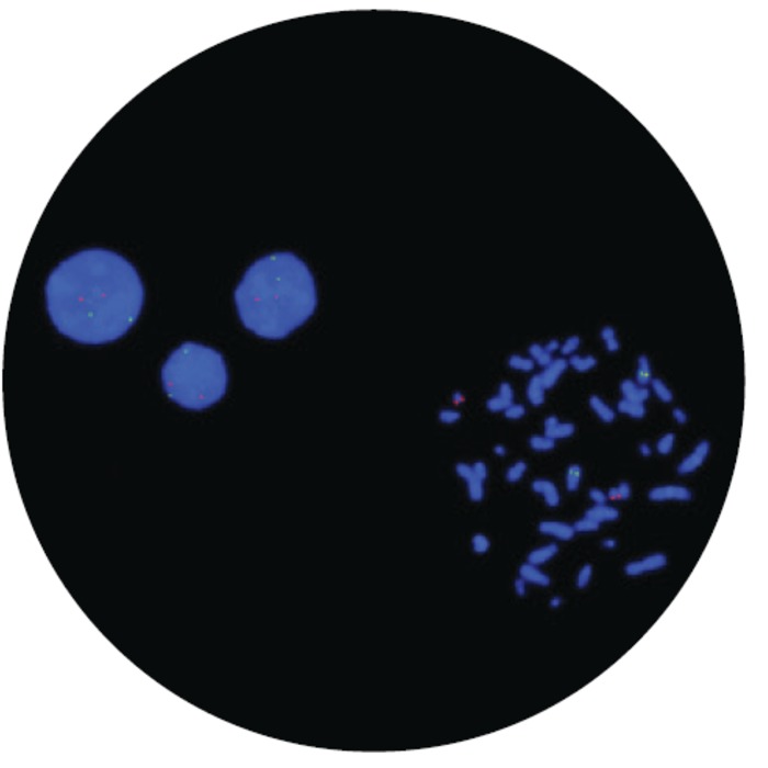 Fluorescence in situ hybridization microscope image of the FDA-cleared CytoCell AML1/ETO Translocation, Dual Fusion probe.