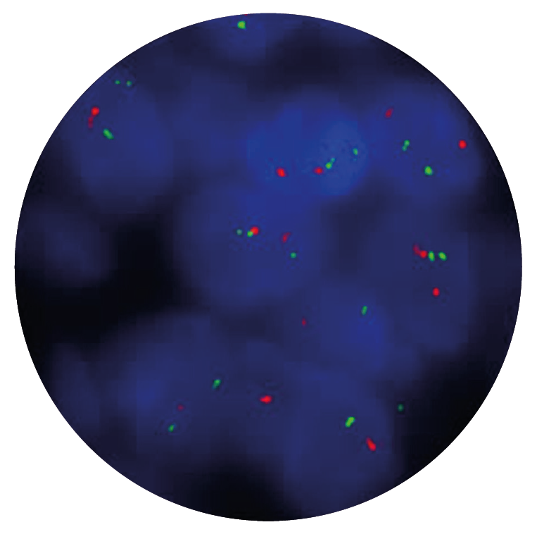 Fluorescence in situ hybridisation (FISH) microscope image of the CytoCell FLI1/EWSR1 Translocation, Dual Fusion probe.