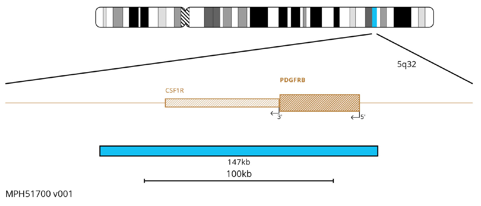 Fluorescence in situ hybridisation (FISH) chromosome map showing a probe targeting the PDGFRB and CSF1R genes.
