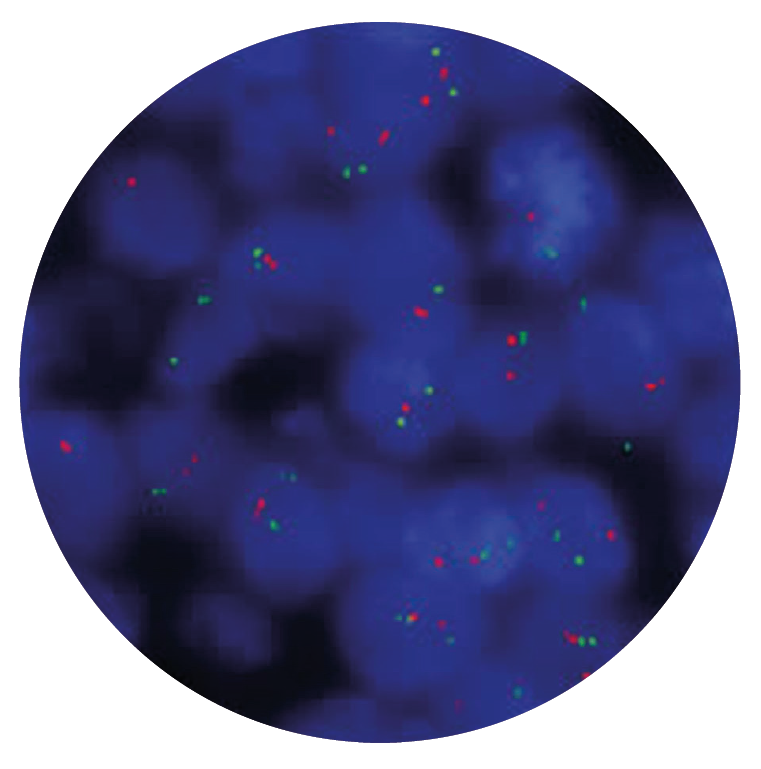 Fluorescence in situ hybridisation (FISH) microscope image of the CytoCell EWSR1/ERG Translocation, Dual Fusion probe.