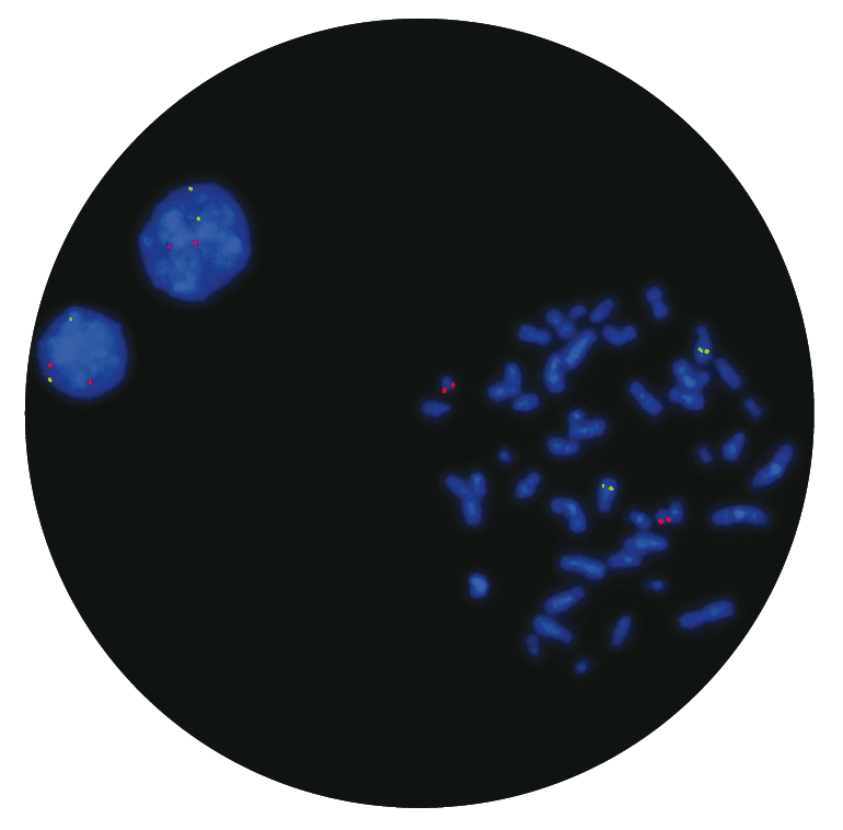 Fluorescence in situ hybridisation (FISH) microscope image of the CytoCell AML1/ETO Translocation, Dual Fusion probe.
