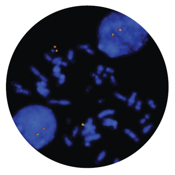 Fluorescence in situ hybridization (FISH) microscope image of the FDA-cleared CytoCell MLL (KMT2A) Breakapart probe.