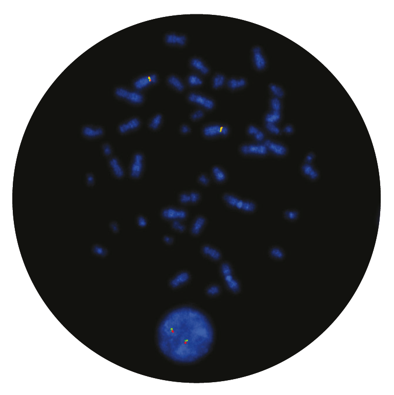 Fluorescence in situ hybridisation (FISH) microscope image of the CytoCell FIP1L1/CHIC2/PDGFRA Deletion/Fusion probe.
