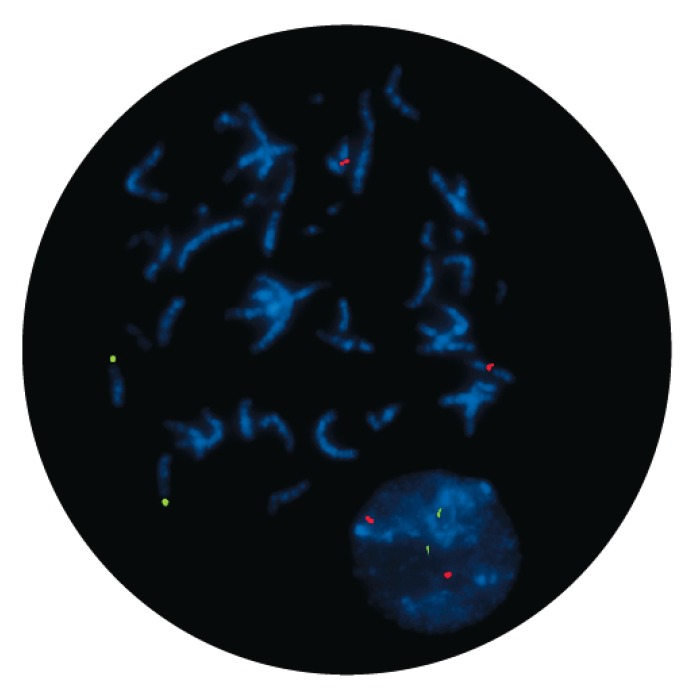Fluorescence in situ hybridization (FISH) microscope image of the CytoCell IGH/MYEOV Translocation, Dual Fusion probe.