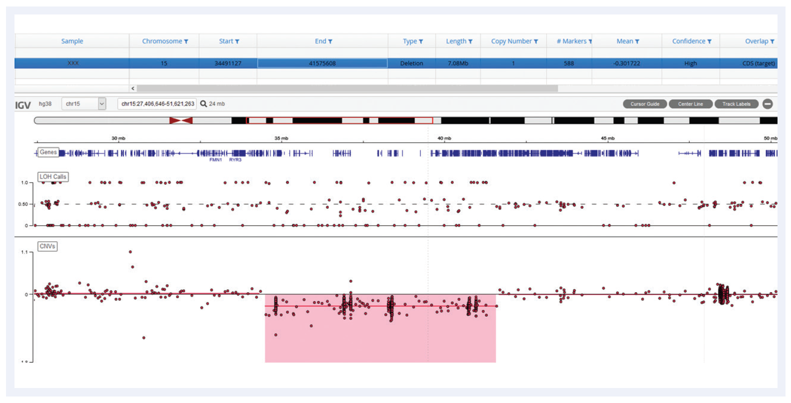 Next generation sequencing (NGS) software data showing a sample with a 7Mb deletion at 15q14q15.1 within a mosaic sample.