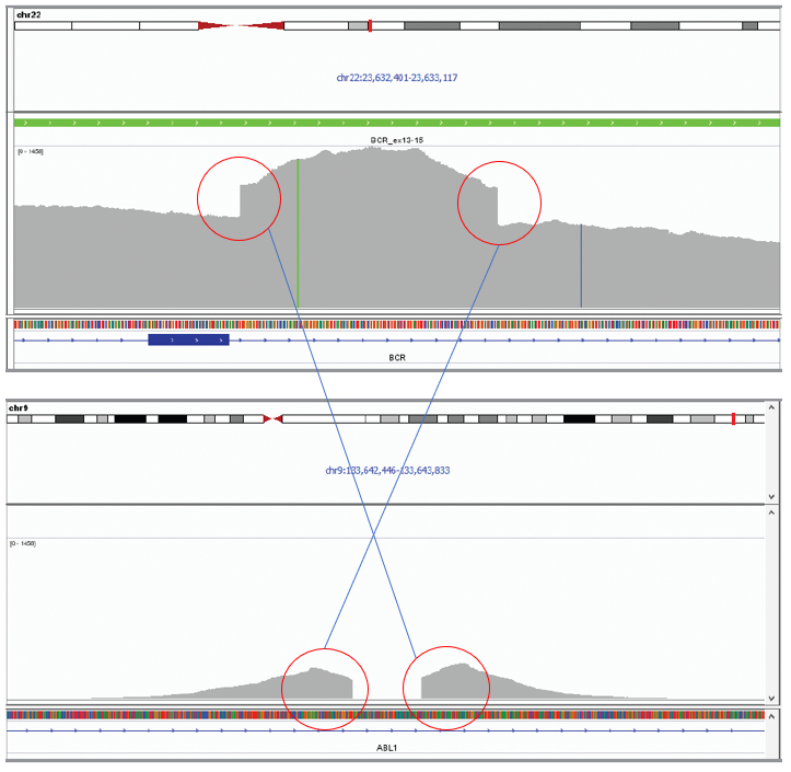 Next generation sequencing (NGS) software data showing BCR-ABL1 (chromosome 22) and ABL1-BCR (chromosome 9) translocations.