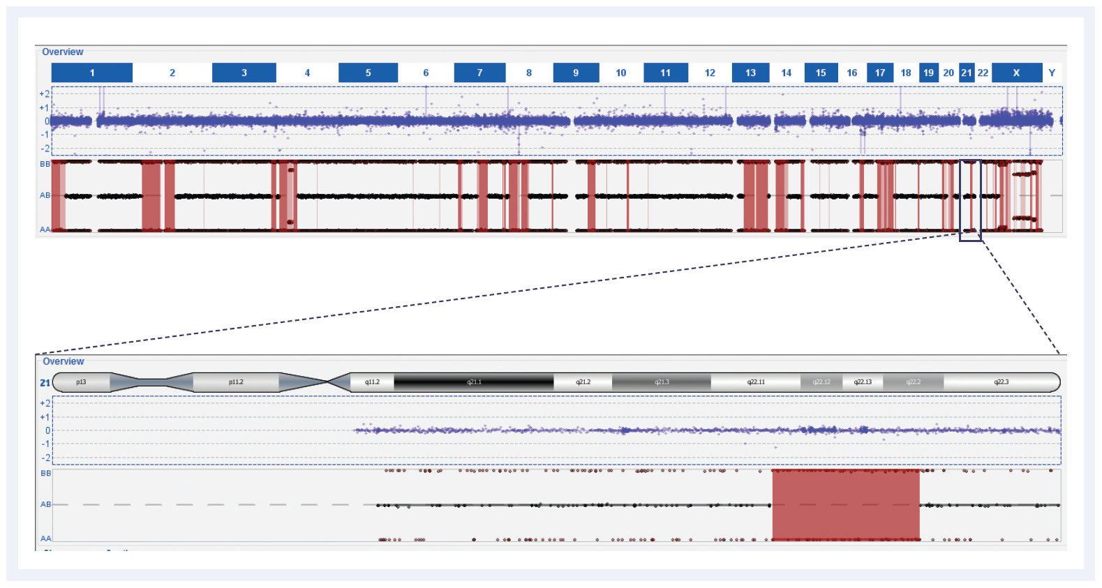 aCGH software data showing multiple regions of homozygosity associated with parental consanguinity.