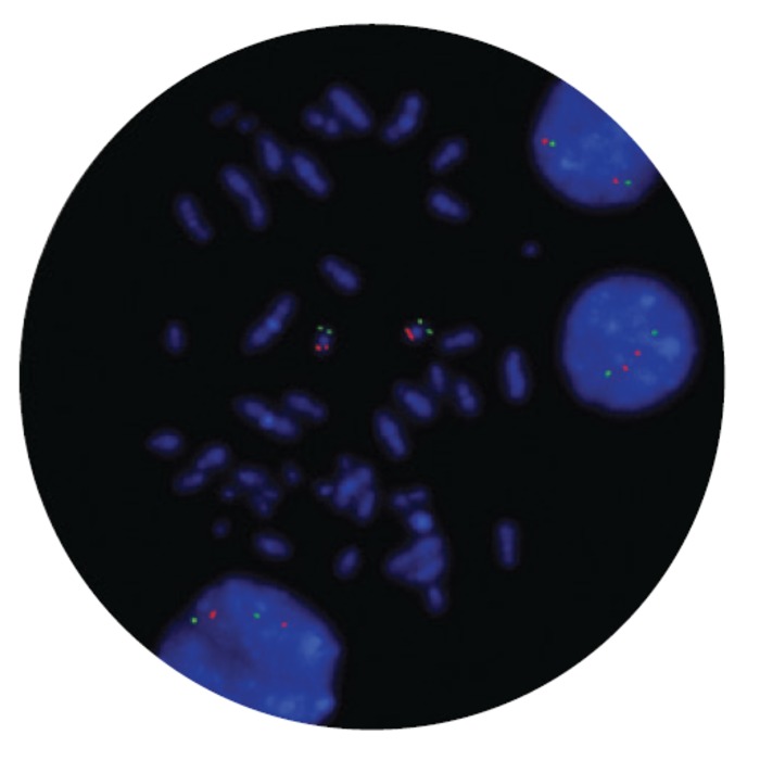 Fluorescence in situ hybridization microscope image of the FDA-cleared CytoCell CBFB/MYH11 Translocation, Dual Fusion probe.