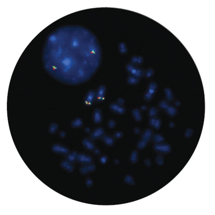 Fluorescence in situ hybridization (FISH) microscope image of the FDA-cleared CytoCell EVI1 (MECOM) Breakapart probe.
