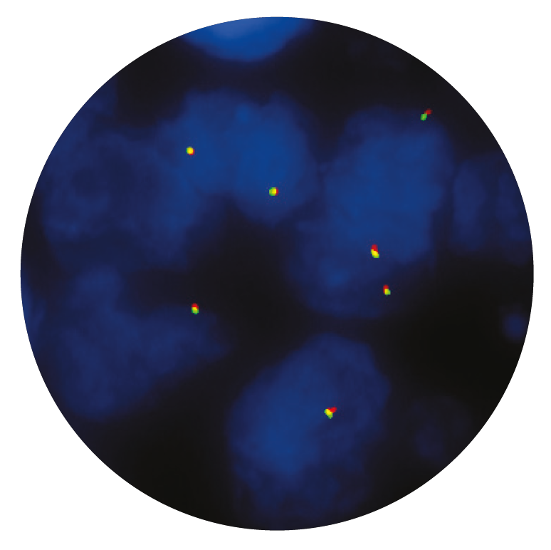 Fluorescence in situ hybridization (FISH) microscope image of the CytoCell SYT (SS18) Breakapart probe.