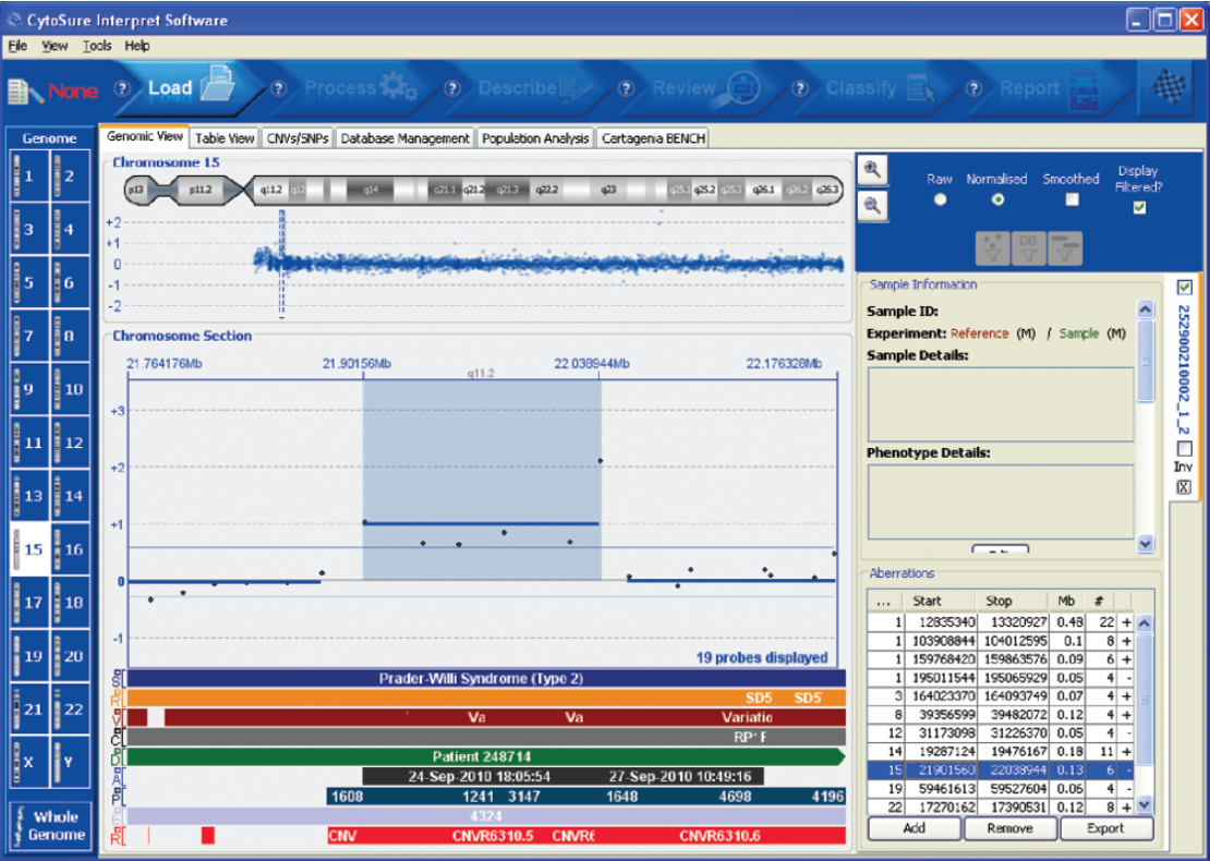 aCGH software data showing detection of a small (130kb) DNA amplification.